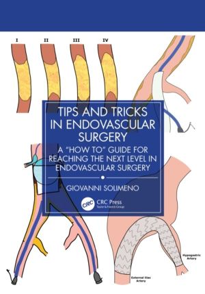 Tips and Tricks in Endovascular Surgery - A "How to" Guide for reaching the