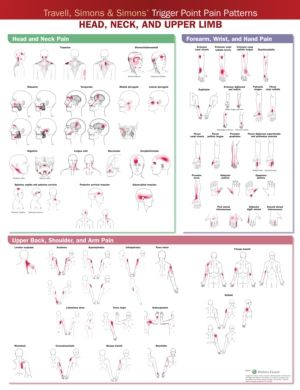 Travell, Simons & SimonsÔÇÖ Trigger Point Pain Patterns Wall Chart - Head,